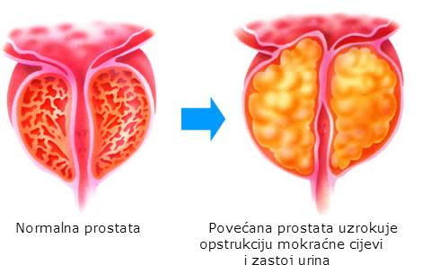 Rezultat slika za prostata
